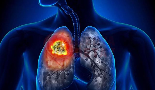 Düşük doz BT ile akciğer kanserinde erken tanı mümkün