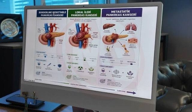 Kan testiyle erken evre pankreas kanserinin yüzde 90’ı tespit edilebiliyor