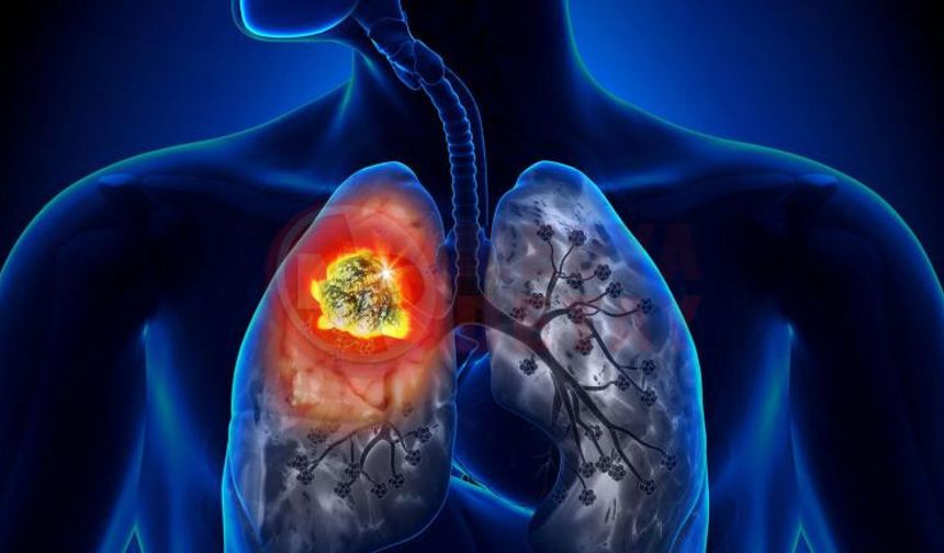 Düşük doz BT ile akciğer kanserinde erken tanı mümkün