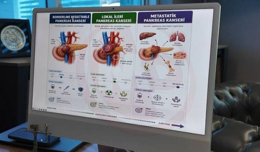 Kan testiyle erken evre pankreas kanserinin yüzde 90’ı tespit edilebiliyor